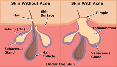 What are the steps of pimple formation to the pimple popping? (Guide to understand your body)